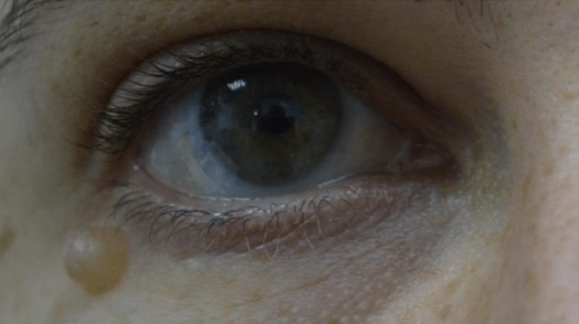 Benign Eyelid Lesion Treatment