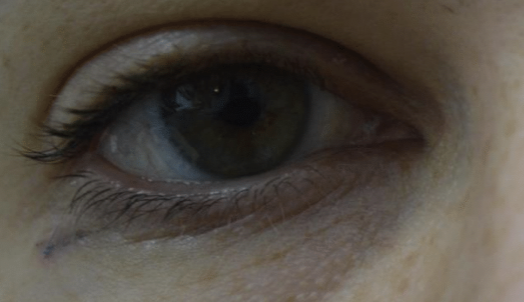 Benign Eyelid Lesion Treatment