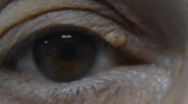 Benign Eyelid Lesion Treatment