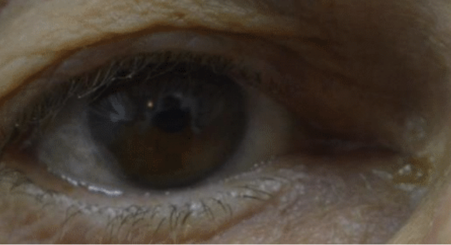 Benign Eyelid Lesion Treatment