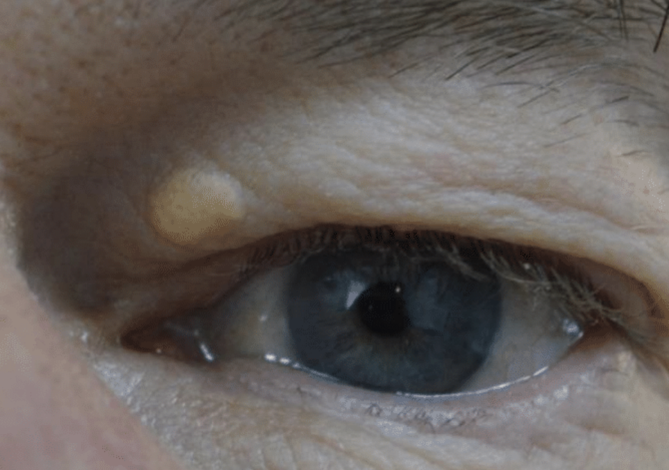 Benign Eyelid Lesion Treatment