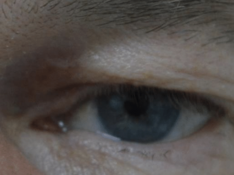 Benign Eyelid Lesion Treatment