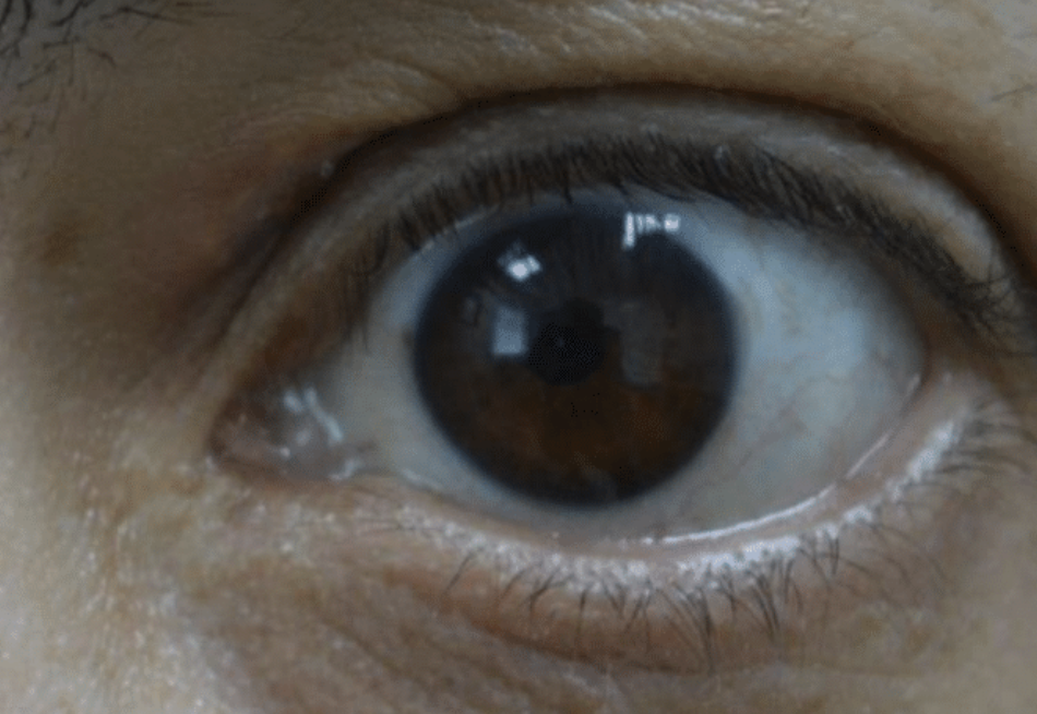 Benign Eyelid Lesion Treatment