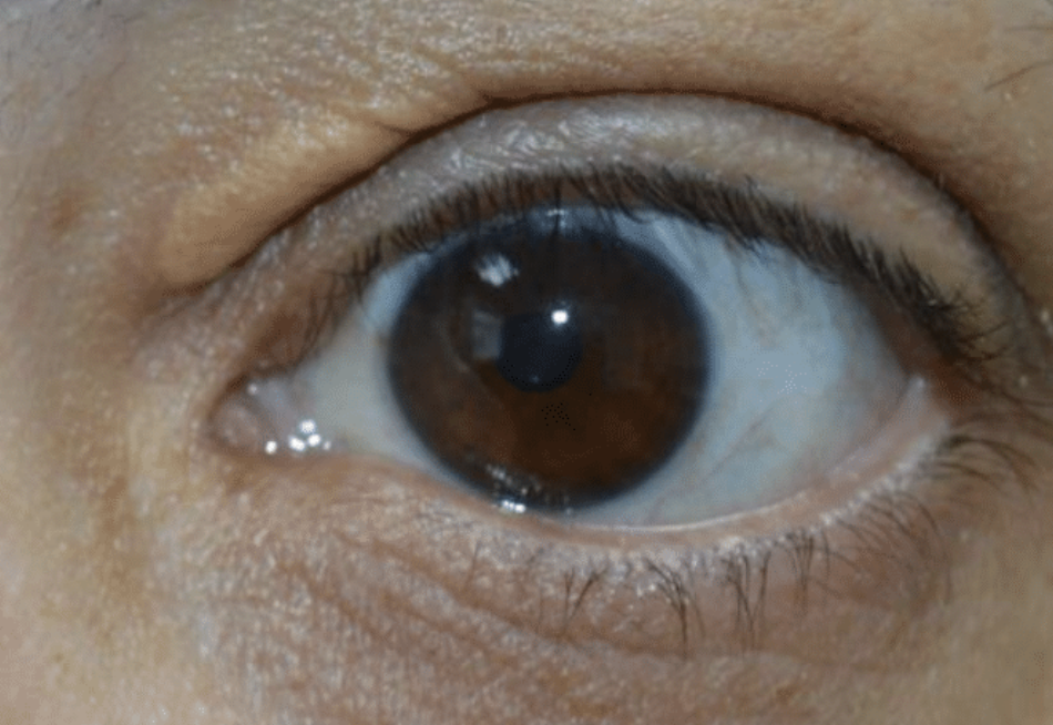 Benign Eyelid Lesion Treatment