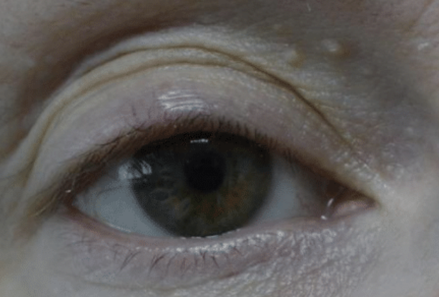 Eyelid Chalazion treatment