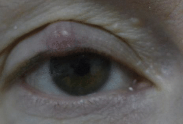 Eyelid Chalazion treatment