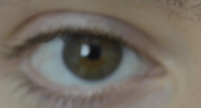 Eyelid Chalazion treatment