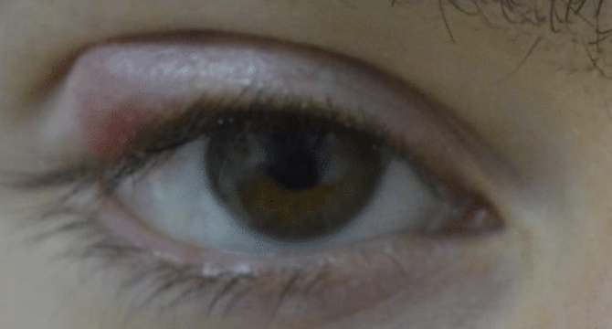 Eyelid Chalazion treatment