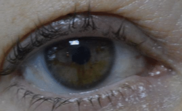 Eyelid Chalazion treatment