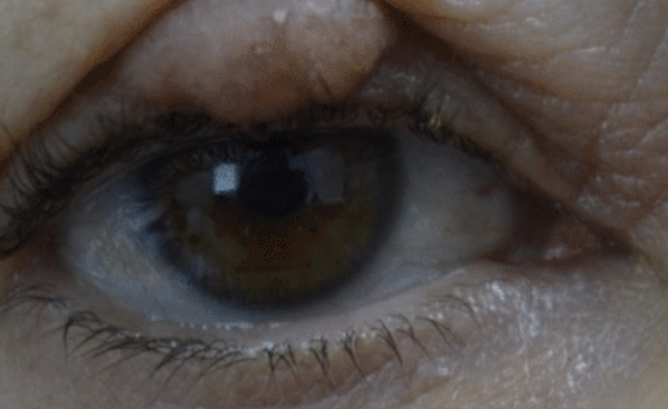 Eyelid Chalazion treatment
