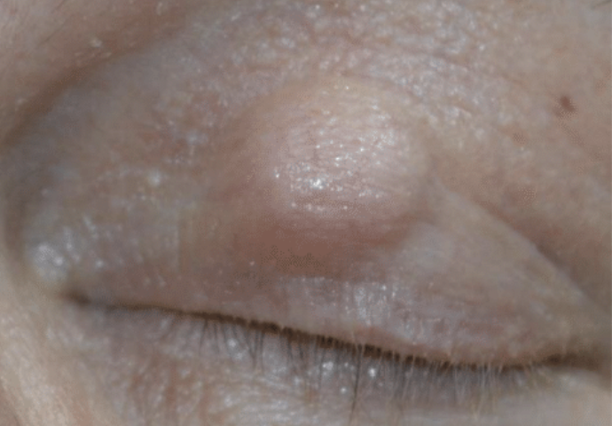 Eyelid Chalazion treatment